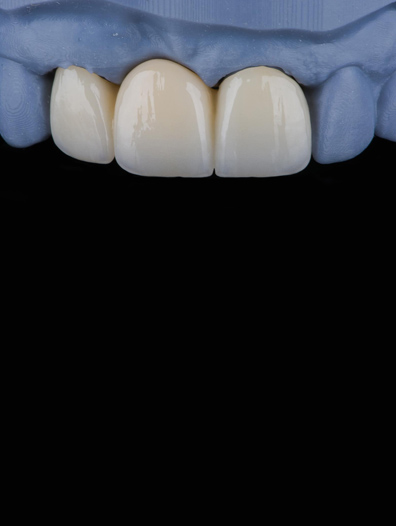 Porcelain CEREC Restoration