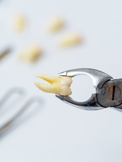 Damaged / infected tooth services